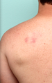 Congenital birthmark treated with IPL on the back