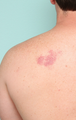 Congenital birthmark treated with IPL on the back