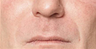 Juvederm