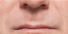 Juvederm
