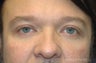 Male -Upper & Lower Blepharoplasty, Chin Implant and Submental Liposuction