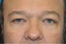 Male -Upper & Lower Blepharoplasty, Chin Implant and Submental Liposuction