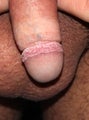 25 year old male with Pearly Penile Papules