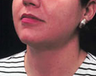 Liposuction