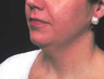 Liposuction