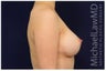 Breast Augmentation
