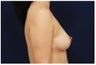 Breast Augmentation