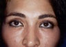A 32 Year Old Female Underwent Eyelid Surgery
