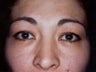A 32 Year Old Female Underwent Eyelid Surgery