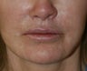Lip Lift and Corner Lift