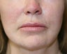 Lip Lift and Corner Lift