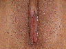Labiaplasty