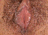 Labiaplasty