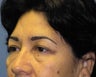Fat transposition quad blepharoplasty