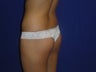 26 year old with buttock implants