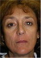 60 Year old female 3 years after Sculpra treatments