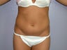 Liposuction