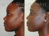 26 Year Old Female African American Rhinoplasty