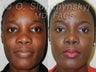 26 Year Old Female African American Rhinoplasty