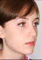 Rhinoplasty for a prominent hump