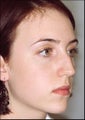 Rhinoplasty for a prominent hump