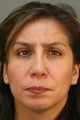Female Revision Rhinoplasty