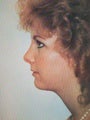 Closed Liposuction with Chin Augmentation