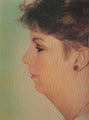 Closed Liposuction with Chin Augmentation