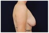 Breast Lift