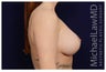 Breast Lift