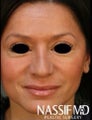 Hispanic Female Rhinoplasty