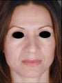 Hispanic Female Rhinoplasty