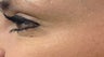 Crows Feet/Forehead