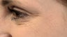 Crows Feet/Forehead