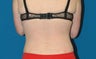 45 year old woman treated with tumescent liposuction to the back regions