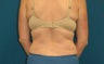 45 year old woman treated with tumescent liposuction to the back regions
