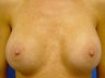 Female Patient Before and After Breast Lift
