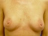Female Patient Before and After Breast Lift