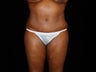 Abdominoplasy with Liposuction