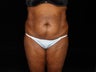Abdominoplasy with Liposuction