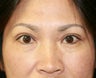 Double Eyelid Procedure