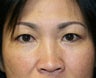 Double Eyelid Procedure
