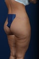 29 Year Old Female - Gluteal Augmentation