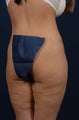 29 Year Old Female - Gluteal Augmentation