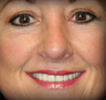Rhinoplasty