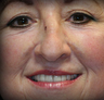 Rhinoplasty