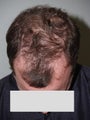 Hair Transplant