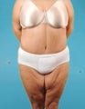 Weight Loss (Massive) & Tummy Tuck
