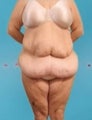Weight Loss (Massive) & Tummy Tuck