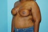 Bilateral DIEP Flap Breast Reconstruction